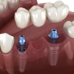 top dental implant clinic in Banjara Hills