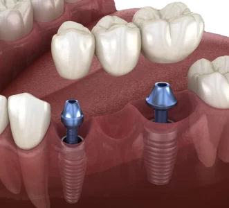 top dental implant clinic in Banjara Hills