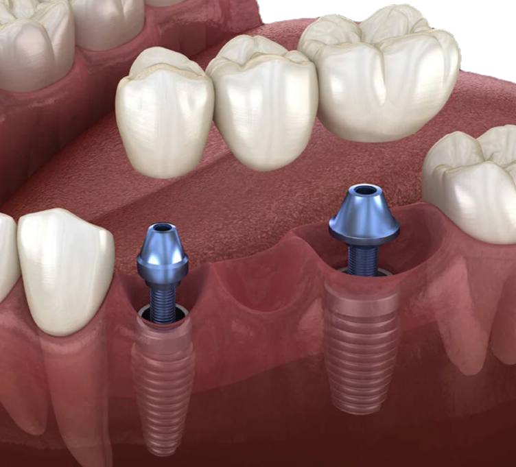 top dental implant clinic in Banjara Hills