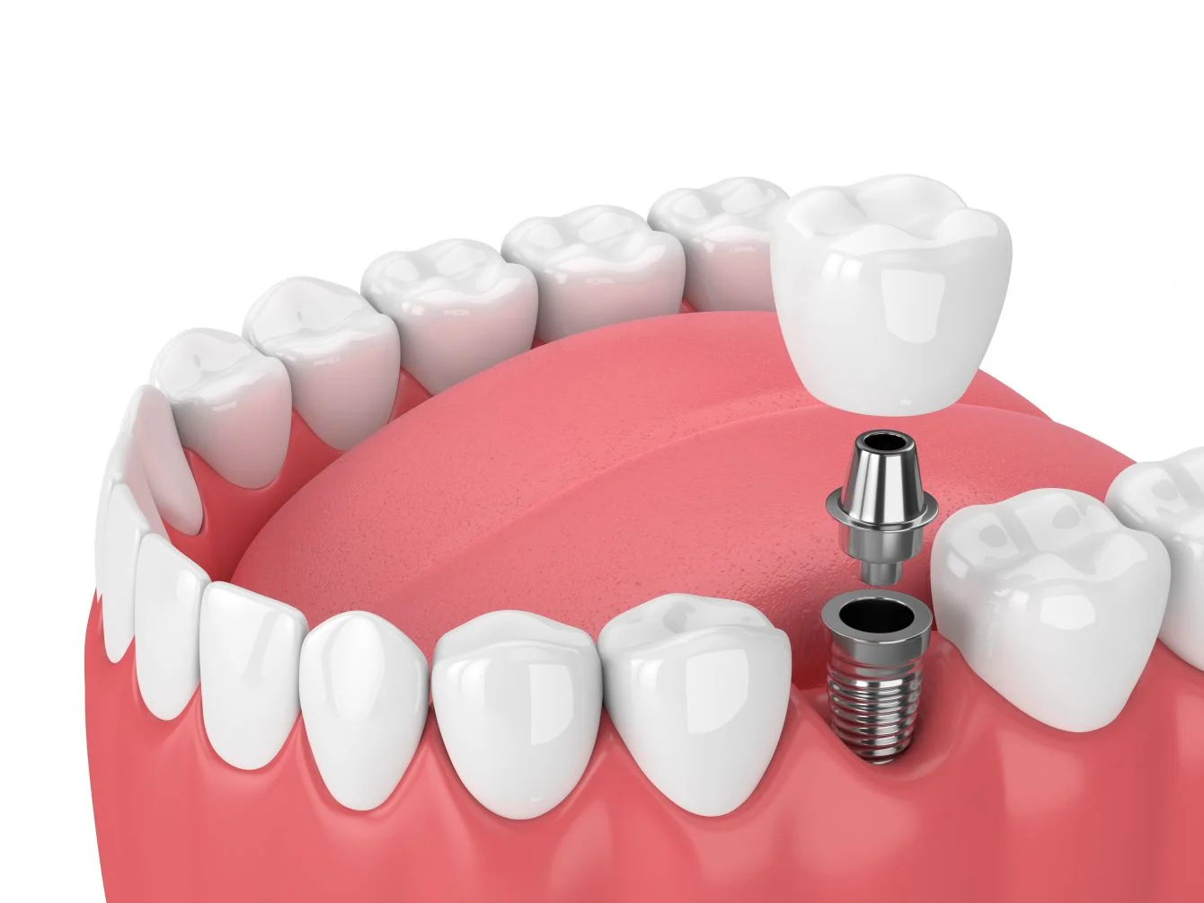 Dental Implants in banjara hills