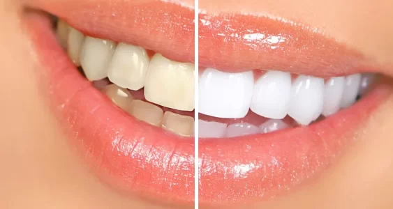 teeth whitening treatment in bajara hills