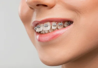 teeth braces invisalign in banjara hills