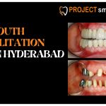 Full Mouth Rehabilitation Cost in Hyderabad