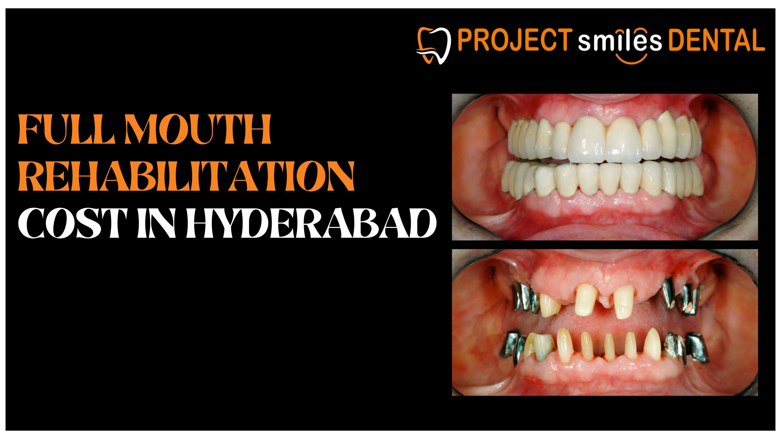 Full Mouth Rehabilitation Cost in Hyderabad