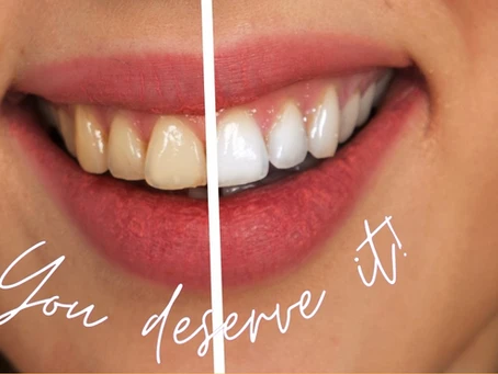 teeth bleaching cost in hyderabad