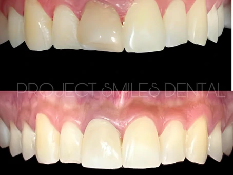 Cosmetic Dentistry Options: smile designing cost in hyderabad