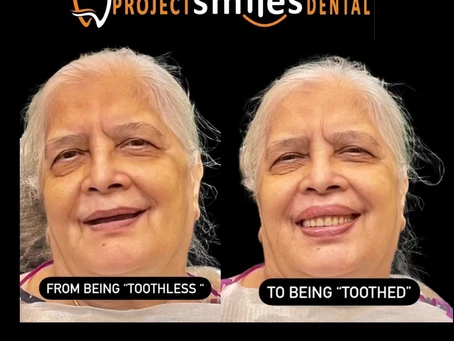 Full Mouth Dental Implants in Banjara Hills, Hyderabad