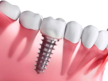 root canal treatment cost