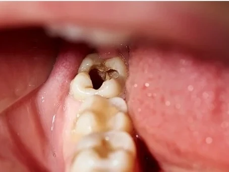 Toothache Bothering: laser dentistry in banjara hills