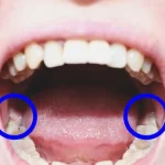 root canal treatment and capping cost