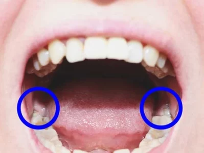 root canal treatment and capping cost