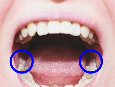 root canal treatment and capping cost