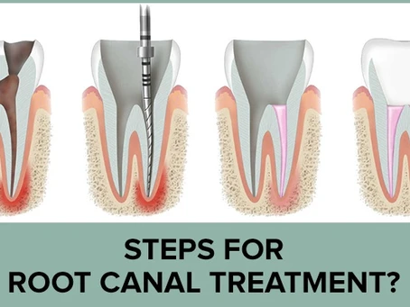 Root Canal Treatment in banjara hills
