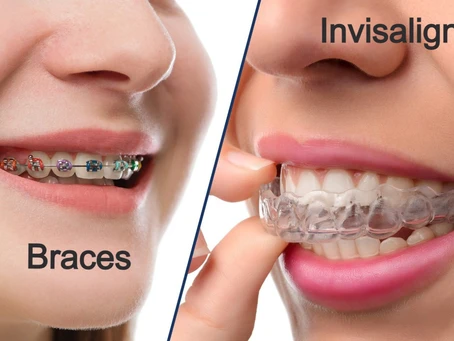 invisalign treatment in banjara hills