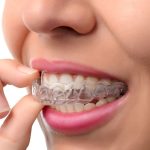 Invisalign Braces in Hyderabad