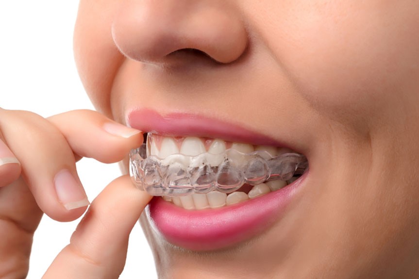 Invisalign Braces in Hyderabad