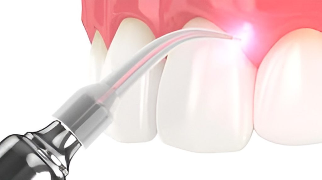 Best Laser Gum Surgery in Hyderabad