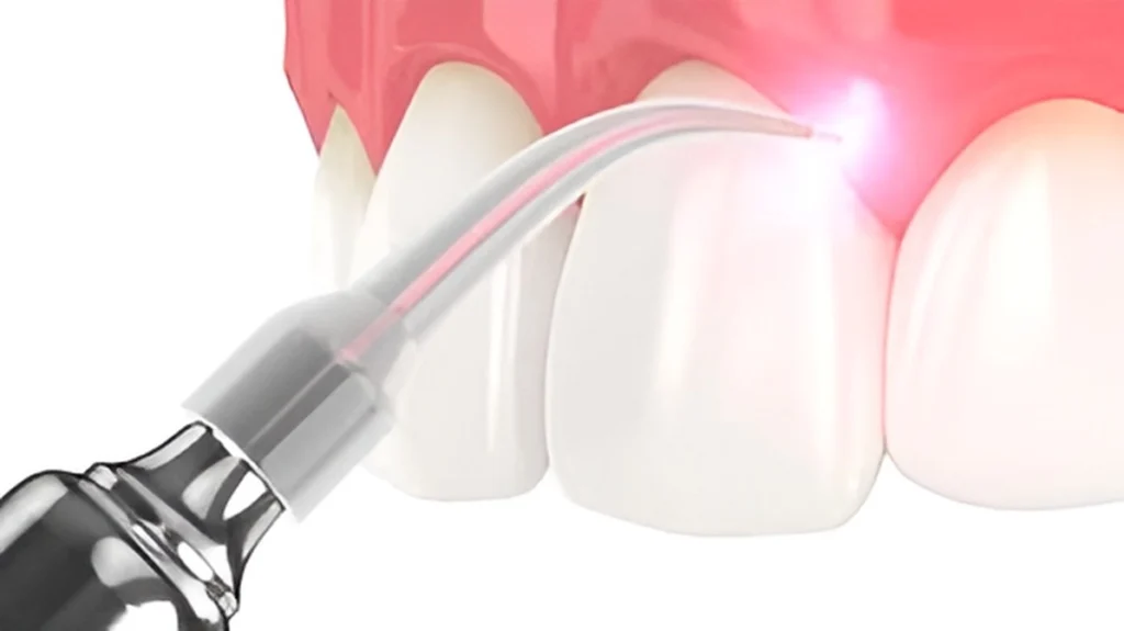 Best Laser Gum Surgery in Hyderabad