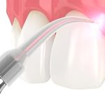 Best Laser Gum Surgery in Hyderabad