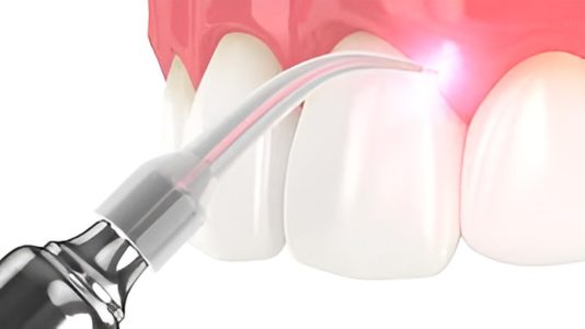 Best Laser Gum Surgery in Hyderabad