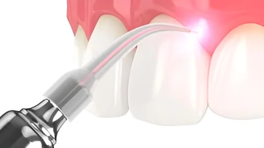 Best Laser Gum Surgery in Hyderabad