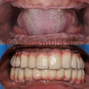 dental impalnts 1