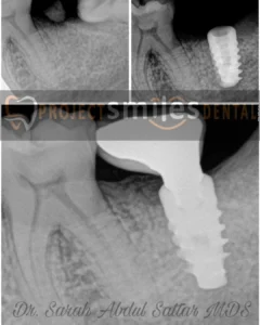 dental implant