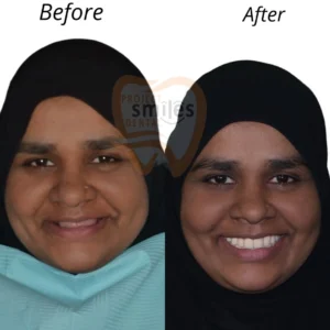 dental implants