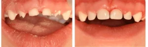 laser gum surgery 1
