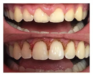 laser gum surgery