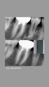 root canal 1