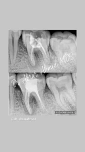 root canal 2