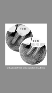 root canal 5