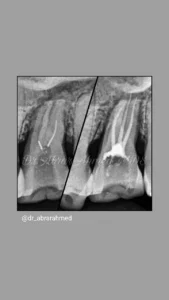 root canl