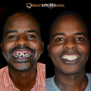 smile makeover