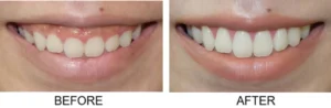 teeth whitening 1