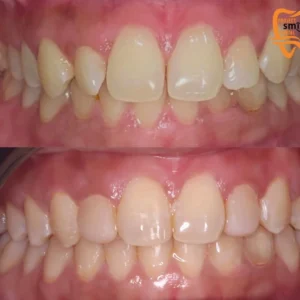 teeth whitening 2