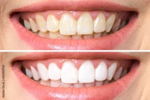 teeth whitening