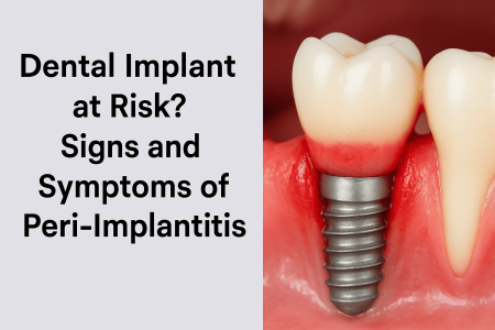 dental implants in hyderabad